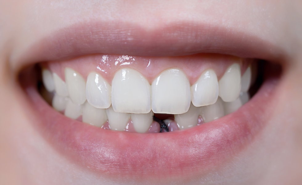 sostituire dente perso implantologia