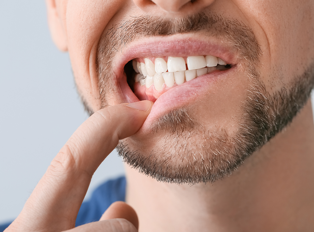 Perchè si muove l’impianto dentale e come prevenire?
