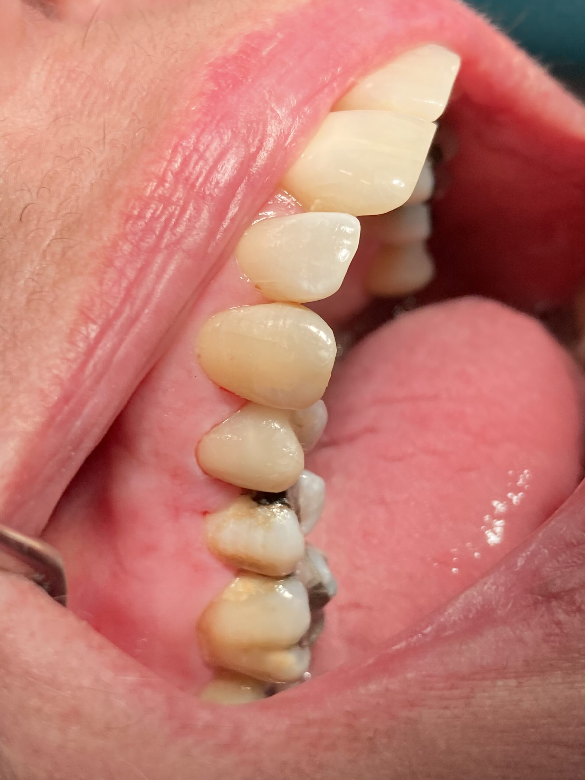ricostruzione denti rotti bologna