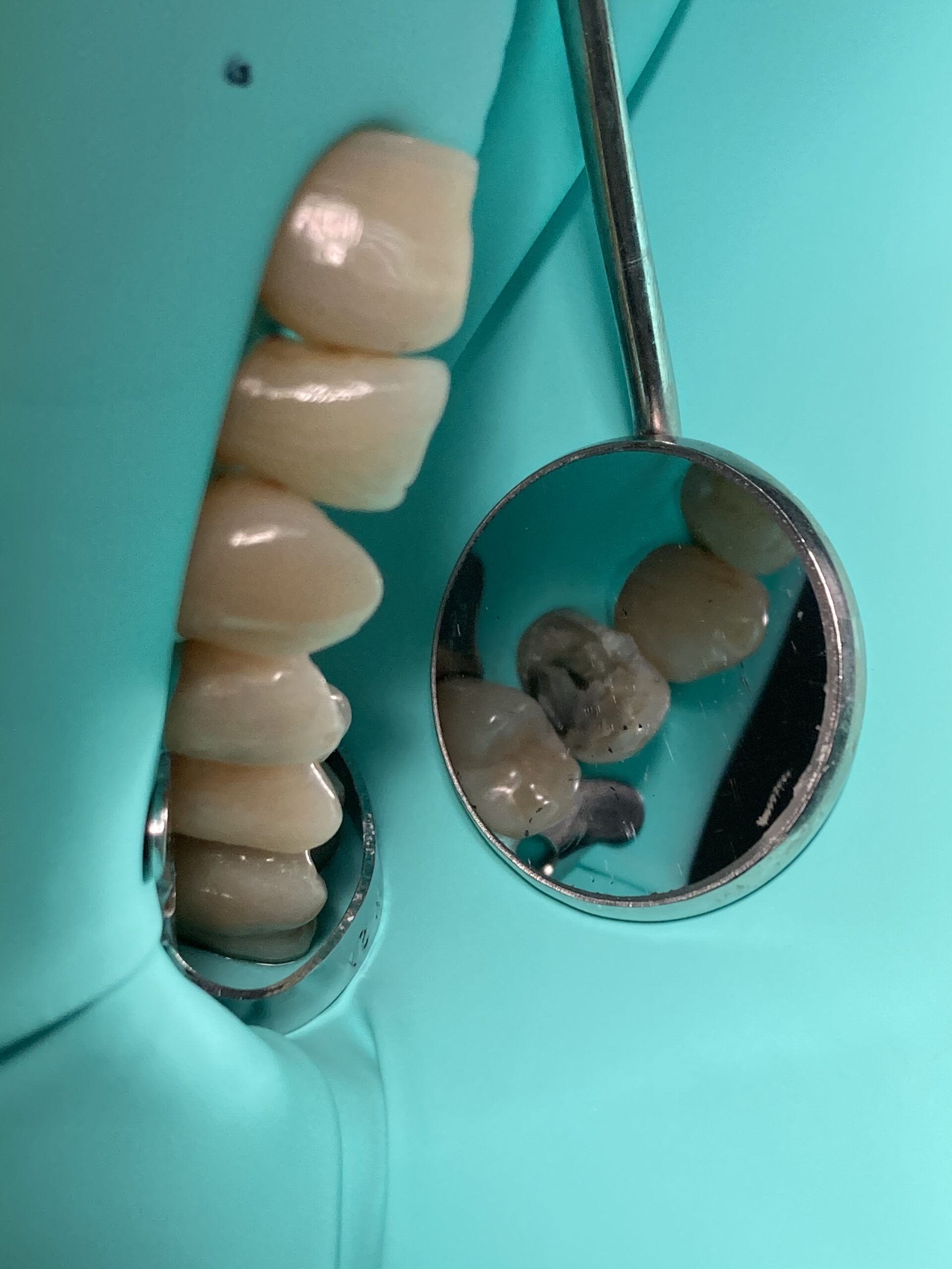 intarsi dentali casi clinici