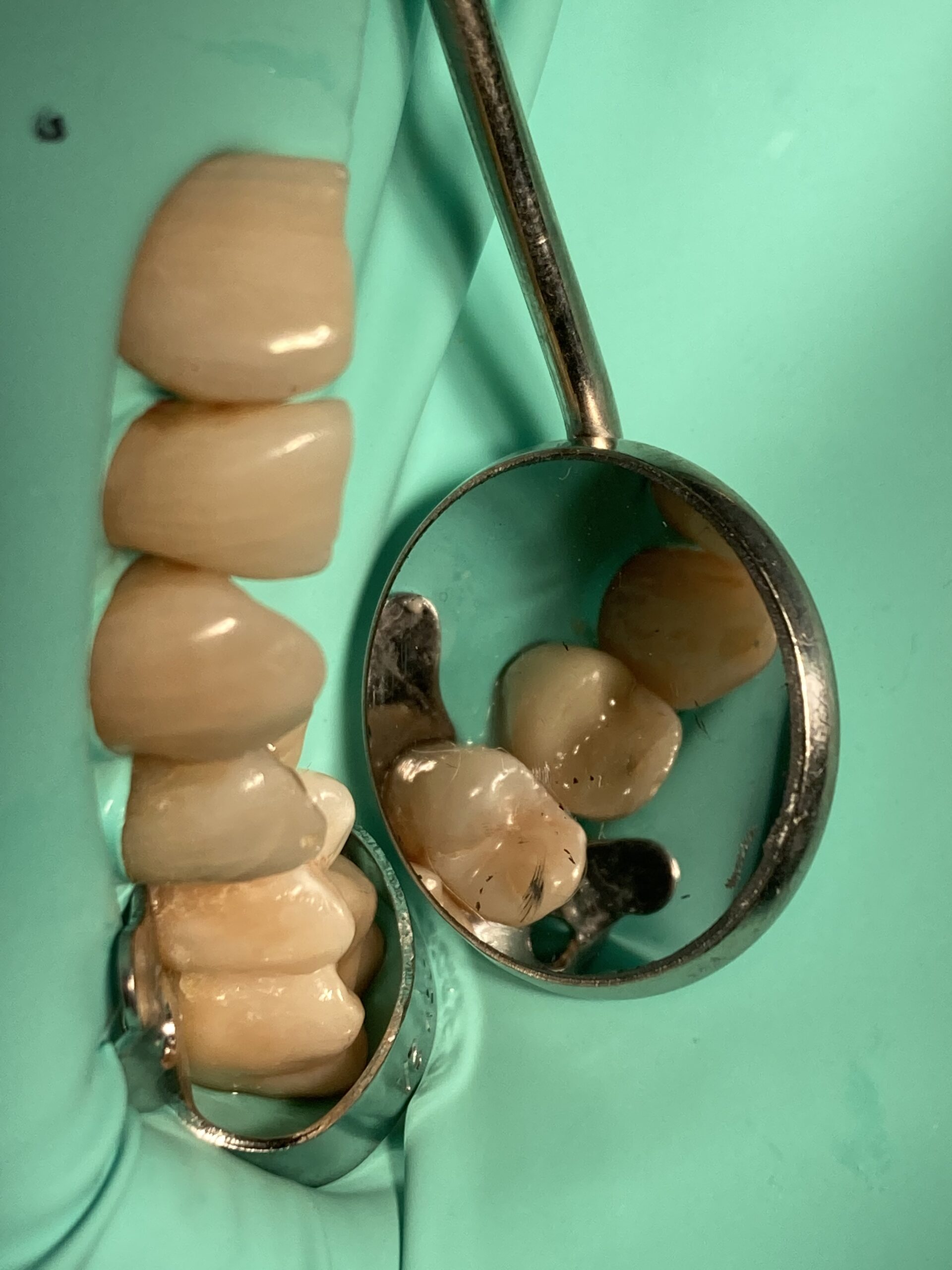intarsi dentali casi clinici