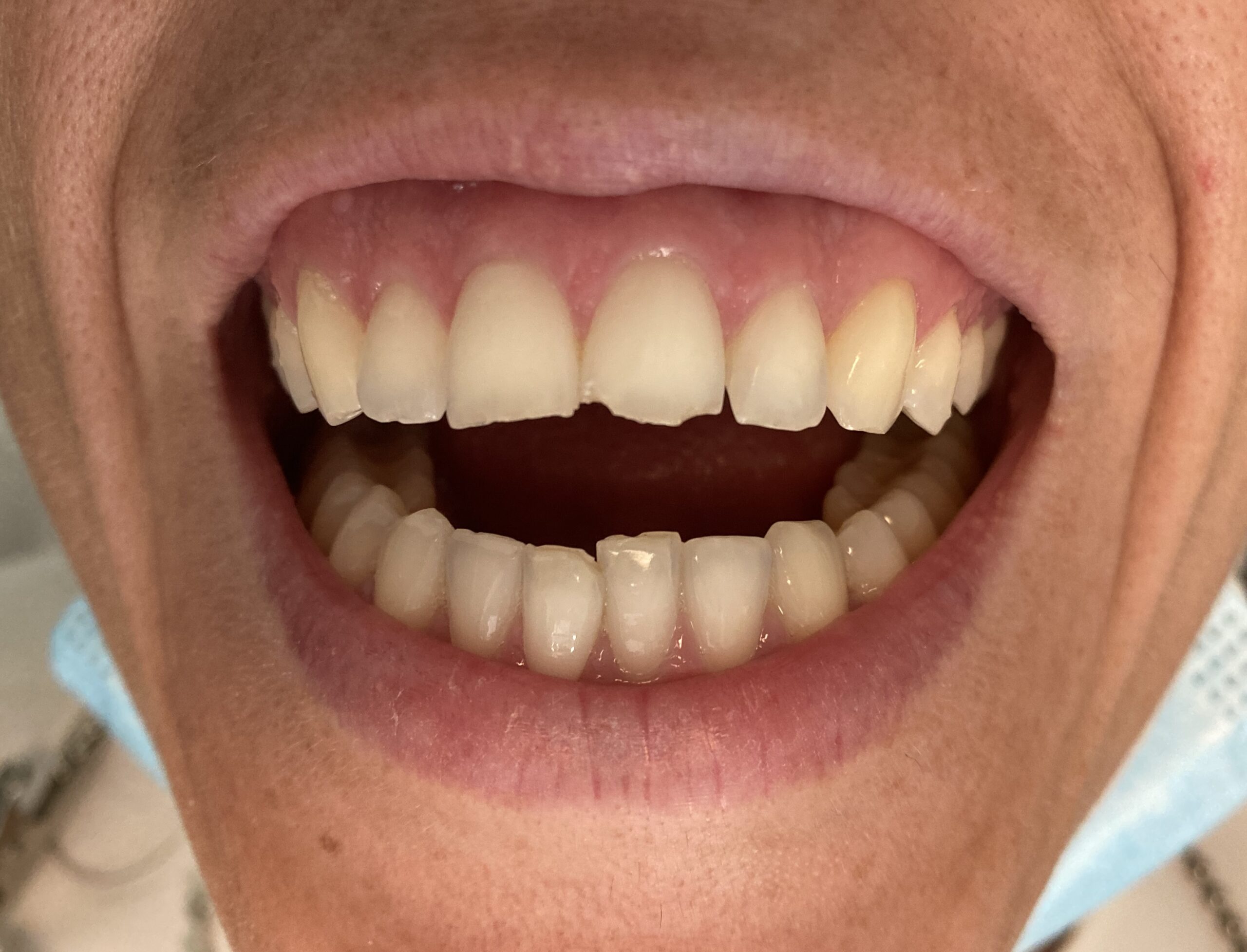 ricostruzione estetica dentale